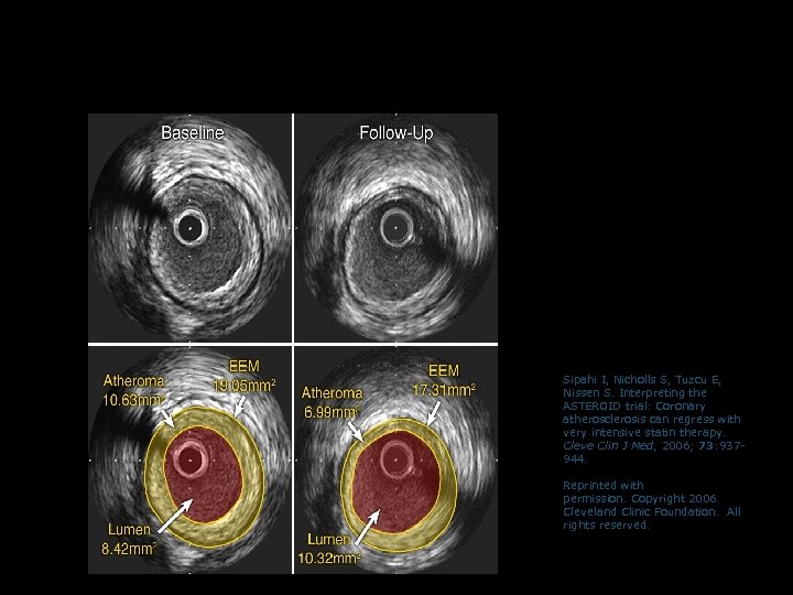 Example of Regression of Atherosclerosis with Rosuvastatin in ASTEROID (measured by IVUS) Sipahi I,