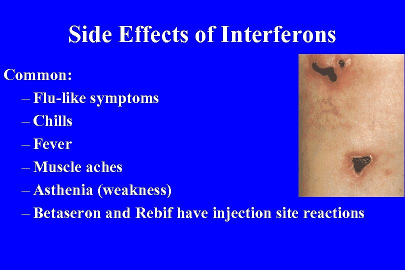Side Effects of Interferons Common: – Flu-like symptoms – Chills – Fever – Muscle