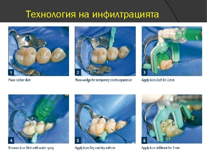 Технология на инфилтрацията 
