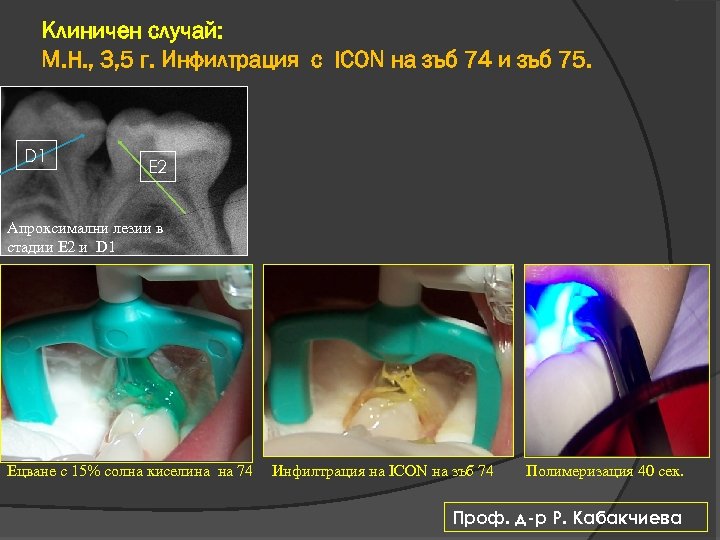 Клиничен случай: М. H. , 3, 5 г. Инфилтрация с ICON на зъб 74