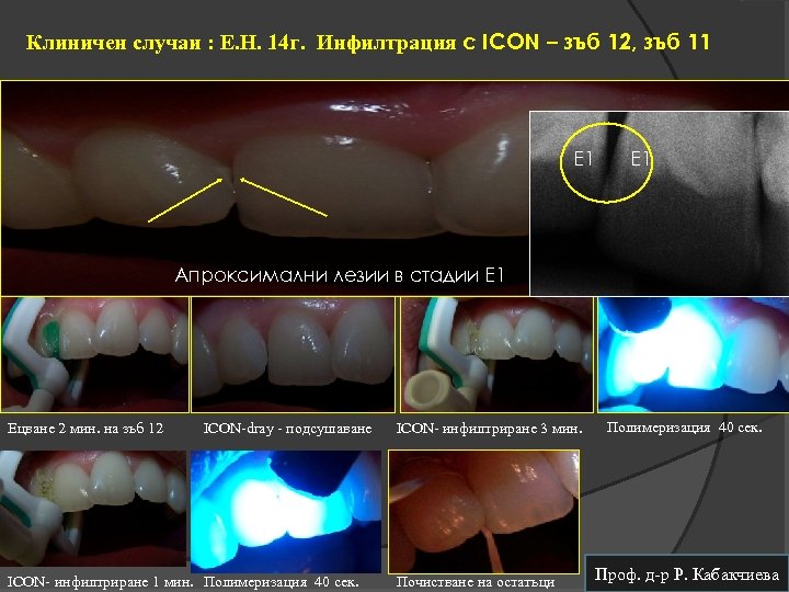 Клиничен случаи : Е. Н. 14 г. Инфилтрация с ICON – зъб 12, зъб