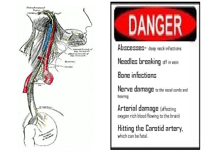 Abscesses- deep neck infections Needles breaking off in vein Bone infections Nerve damage to