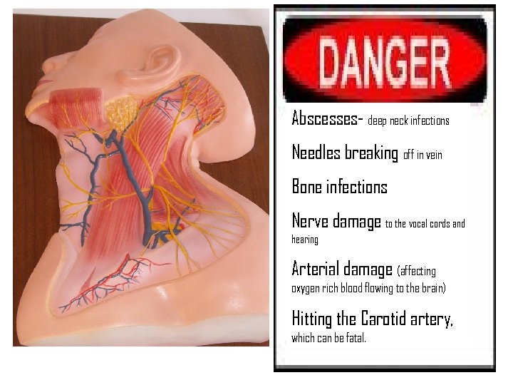 Abscesses- deep neck infections Needles breaking off in vein Bone infections Nerve damage to