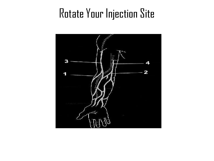 Rotate Your Injection Site 