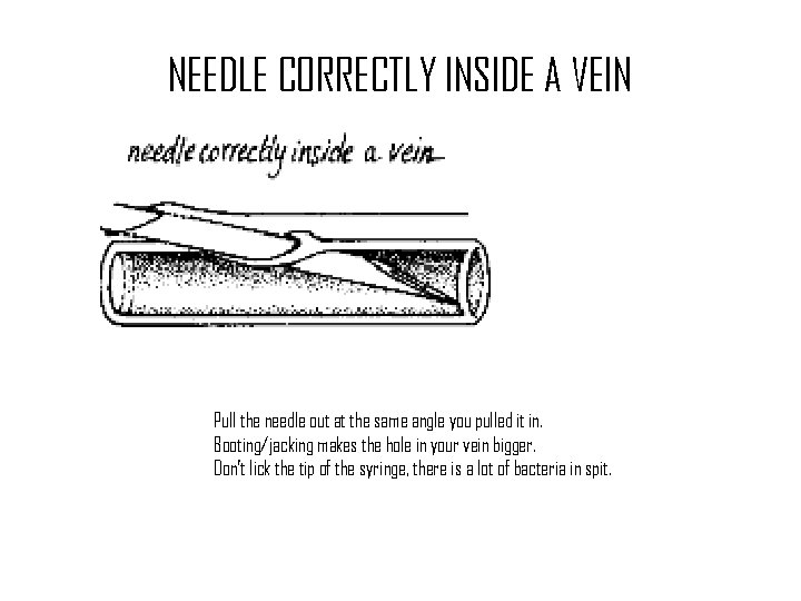 NEEDLE CORRECTLY INSIDE A VEIN Pull the needle out at the same angle you