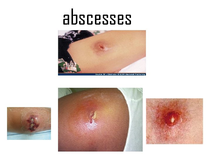 abscesses 