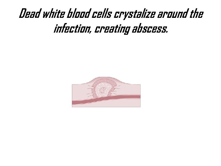 Dead white blood cells crystalize around the infection, creating abscess. 