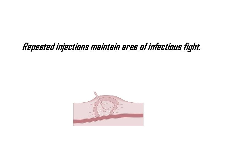 Repeated injections maintain area of infectious fight. 