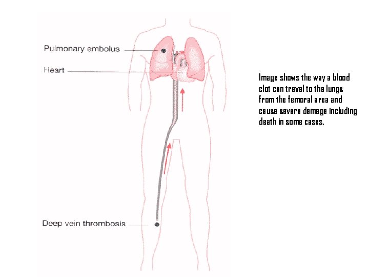 Image shows the way a blood clot can travel to the lungs from the