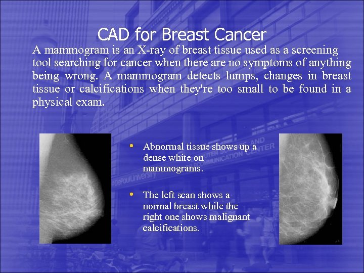 CAD for Breast Cancer A mammogram is an X-ray of breast tissue used as