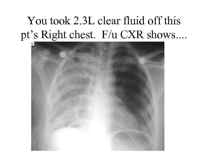 You took 2. 3 L clear fluid off this pt’s Right chest. F/u CXR