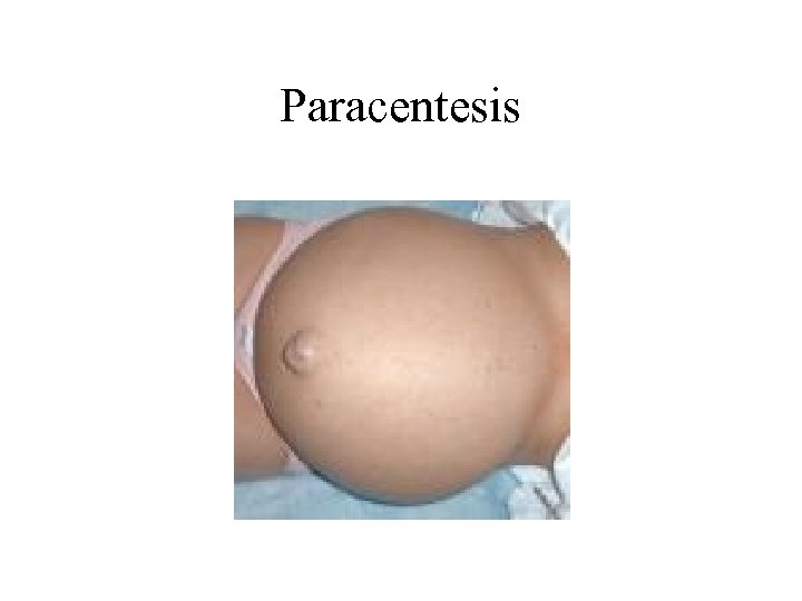 Paracentesis 