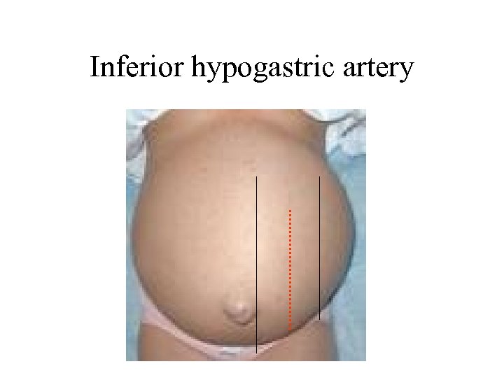 Inferior hypogastric artery 