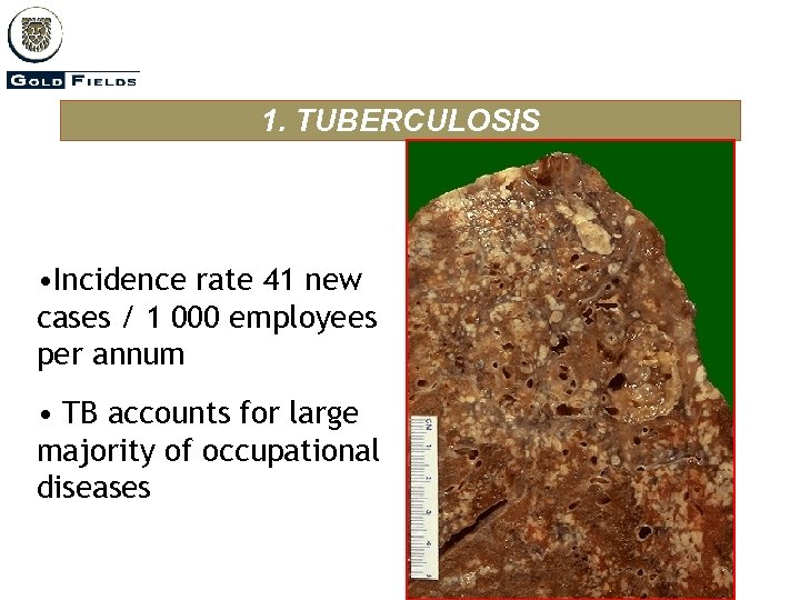 1. TUBERCULOSIS • Incidence rate 41 new cases / 1 000 employees per annum