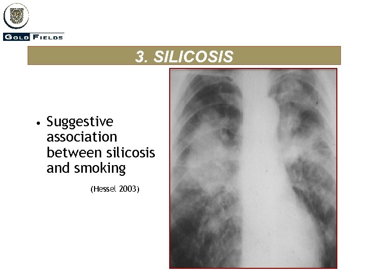 3. SILICOSIS • Suggestive association between silicosis and smoking (Hessel 2003) 