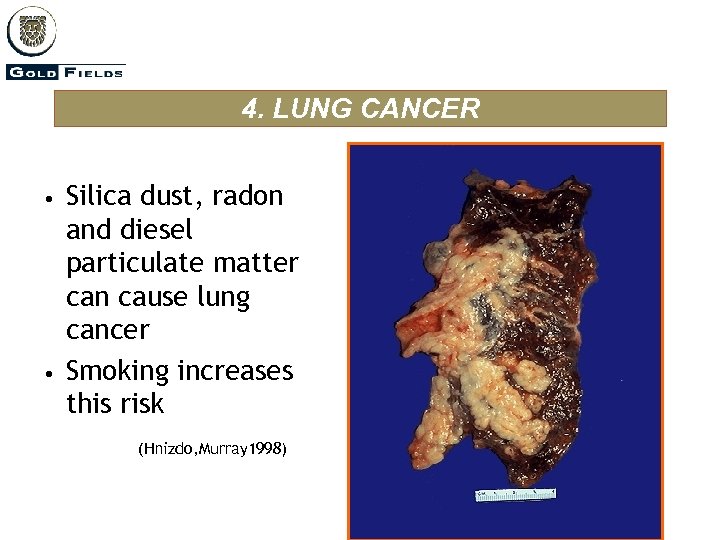 4. LUNG CANCER • • Silica dust, radon and diesel particulate matter can cause