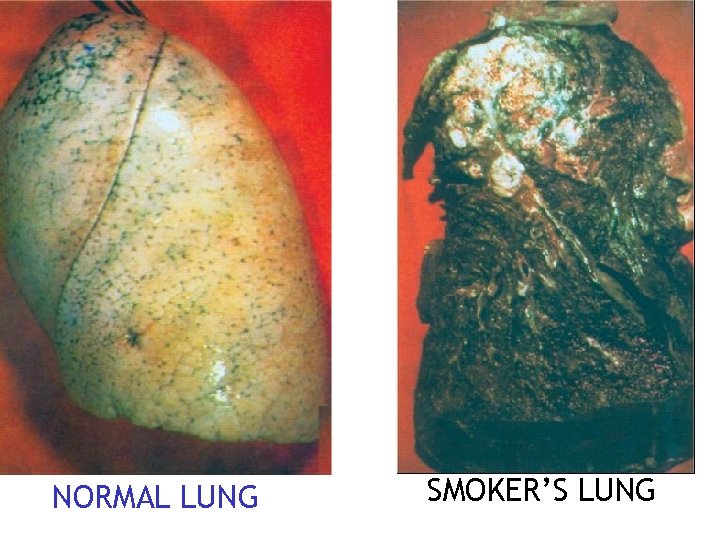 NORMAL LUNG SMOKER’S LUNG 