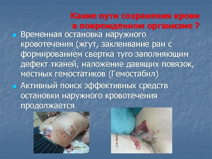 n n Какие пути сохранения крови в поврежденном организме ? Временная остановка наружного кровотечения