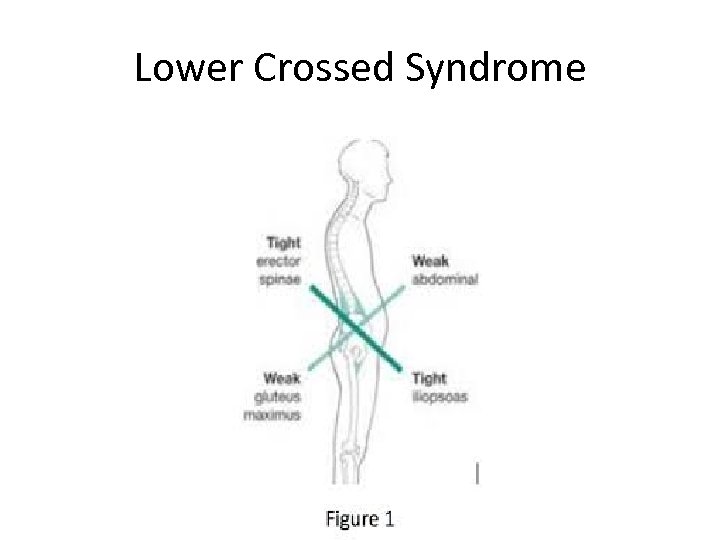 Lower Crossed Syndrome 