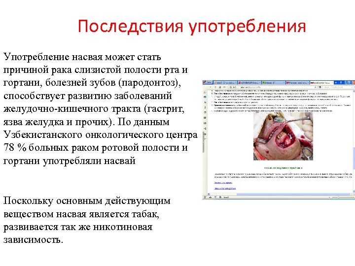 Последствия употребления Употребление насвая может стать причиной рака слизистой полости рта и гортани, болезней
