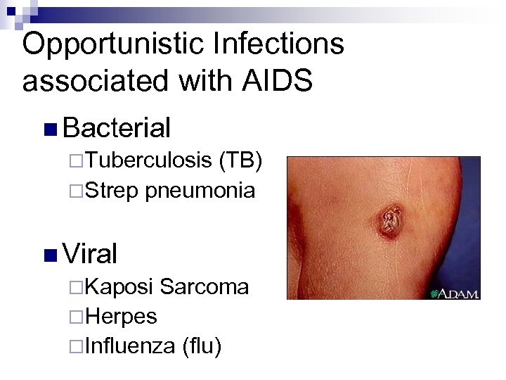 Opportunistic Infections associated with AIDS n Bacterial ¨Tuberculosis (TB) ¨Strep pneumonia n Viral ¨Kaposi