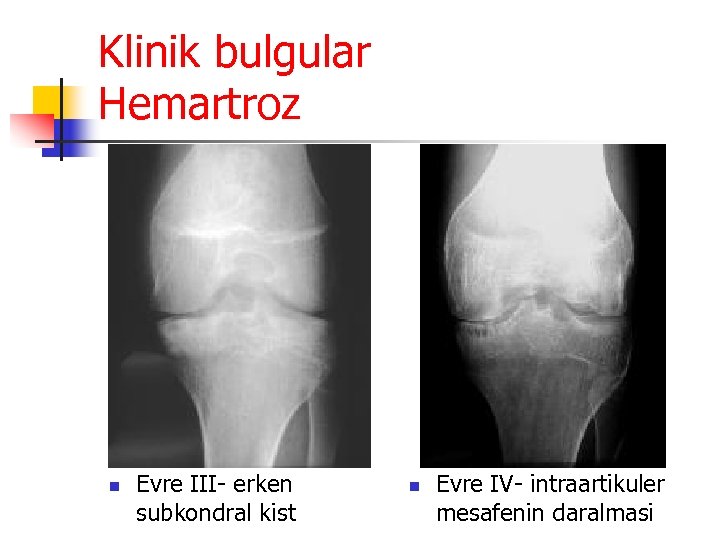 Klinik bulgular Hemartroz n Evre III- erken subkondral kist n Evre IV- intraartikuler mesafenin