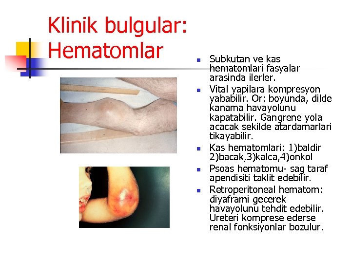Klinik bulgular: Hematomlar n n n Subkutan ve kas hematomlari fasyalar arasinda ilerler. Vital