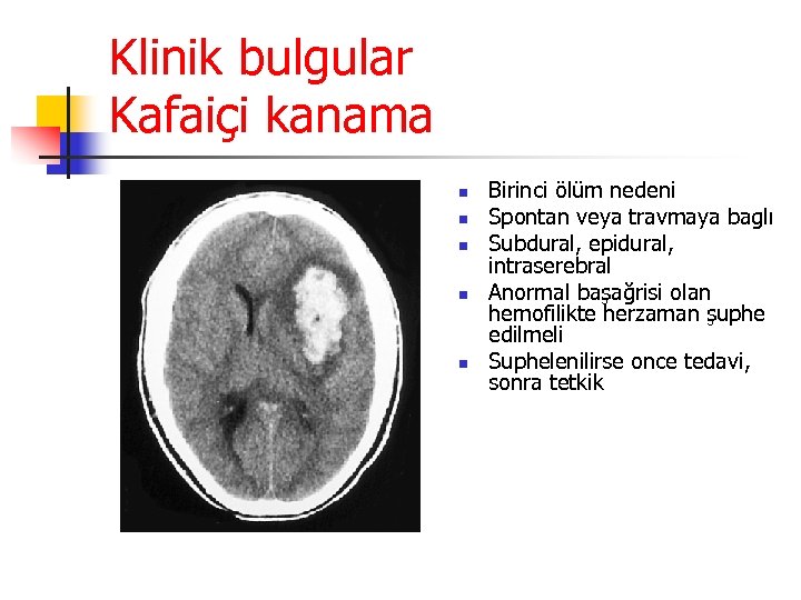 Klinik bulgular Kafaiçi kanama n n n Birinci ölüm nedeni Spontan veya travmaya baglı