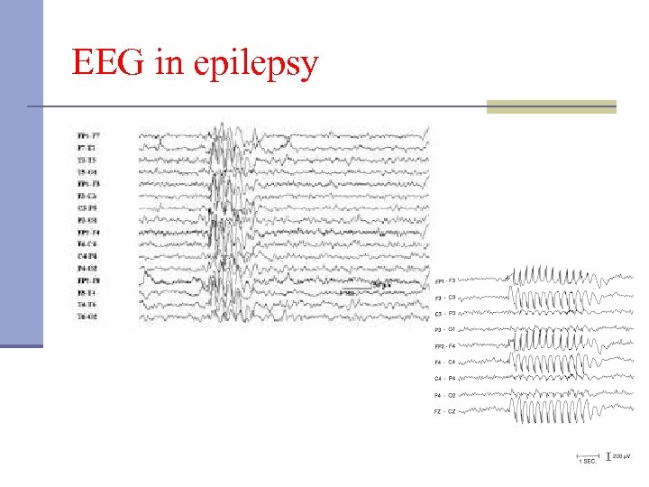 EEG in epilepsy 