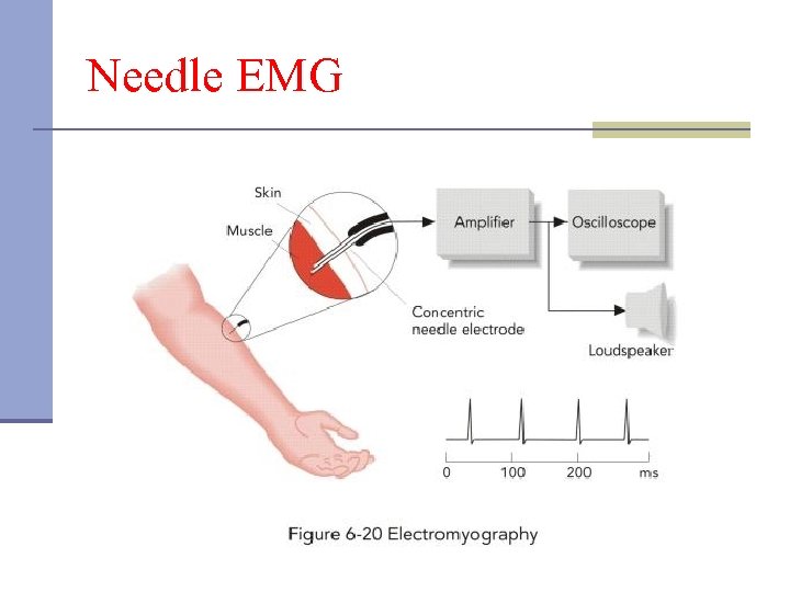 Needle EMG 