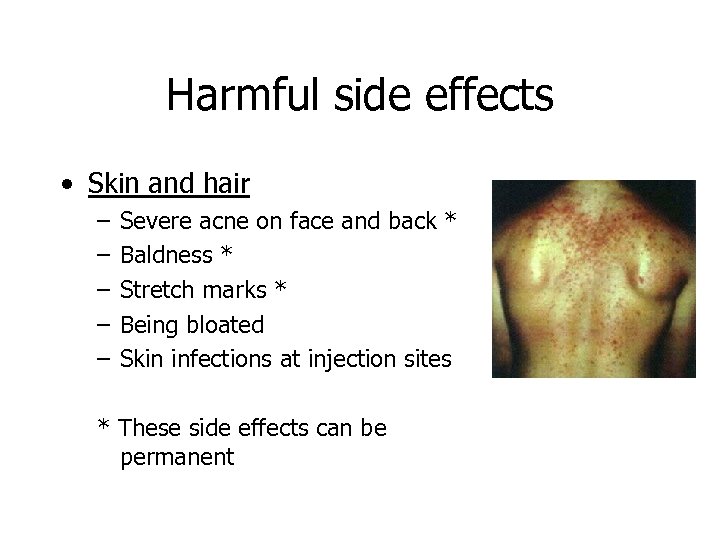 Harmful side effects • Skin and hair – – – Severe acne on face