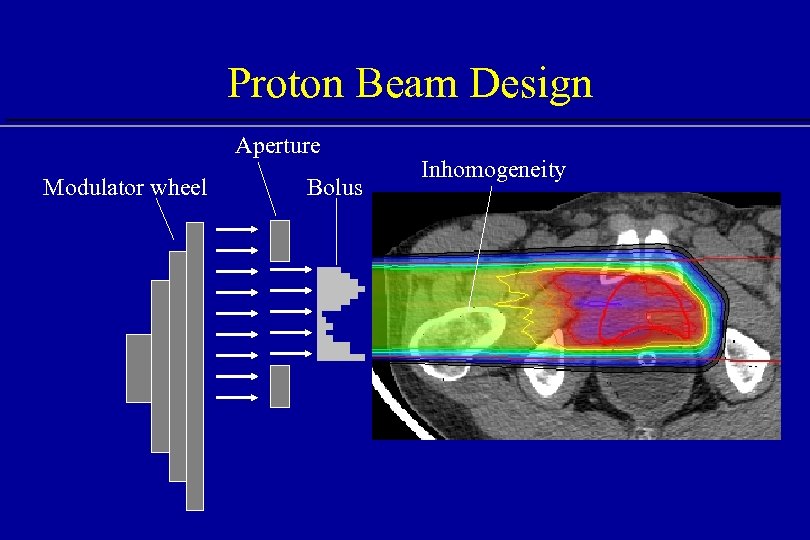 Proton Beam Design Aperture Modulator wheel Bolus Inhomogeneity 