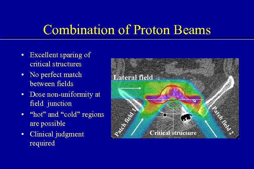 Combination of Proton Beams Lateral field Pa Critical structure d 2 iel tch fie