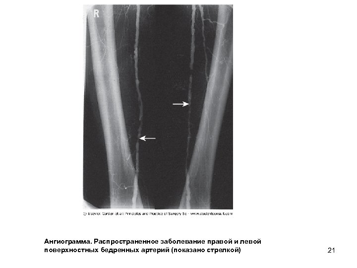 Ангиограмма. Распространенное заболевание правой и левой поверхностных бедренных артерий (показано стрелкой) 21 