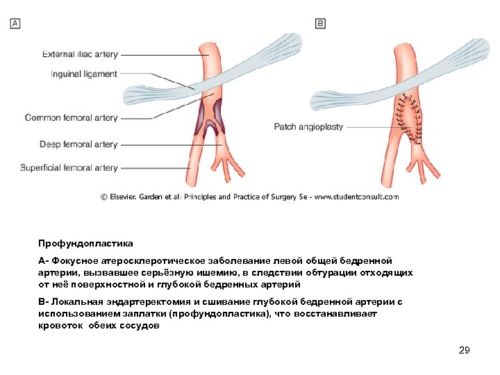 Профундопластика А Фокусное атеросклеротическое заболевание левой общей бедренной артерии, вызвавшее серьёзную ишемию, в следствии