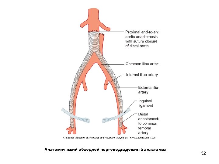 Анатомический обходной аортоподвздошный анастамоз 32 