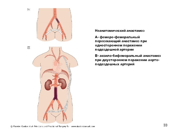 Неанатомический анастамоз А феморо феморальный пересекающий анастамоз при одностороннем поражении подвздошной артерии В аксило