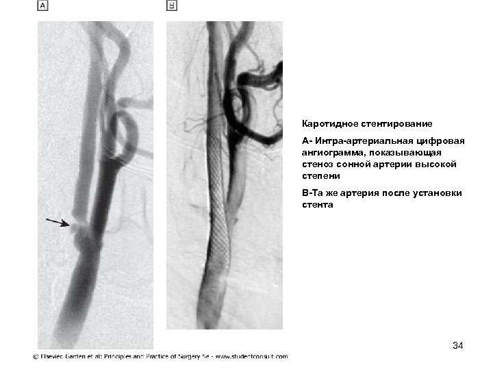 Каротидное стентирование А Интра артериальная цифровая ангиограмма, показывающая стеноз сонной артерии высокой степени В