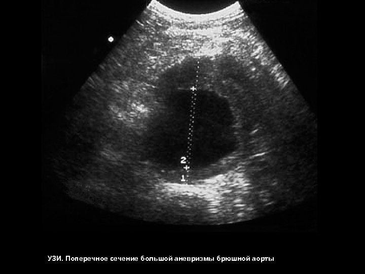 Аневризма аорты узи. Атеросклероз брюшного отдела аорты на УЗИ. Аневризма брюшного отдела аорты на УЗИ. Расслаивающая аневризма аорты УЗИ. Аневризма на УЗИ брюшной полости.