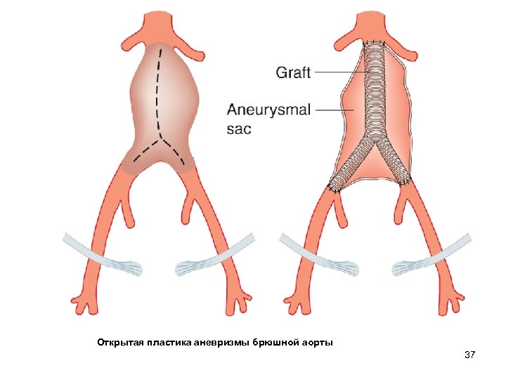 Аневризма брюшной аорты. Эндоваскулярная пластика аорты аневризма. Аневризма брюшной аорты схема. Аневризма подвздошной артерии графт. Веретенообразная аневризма брюшной аорты.