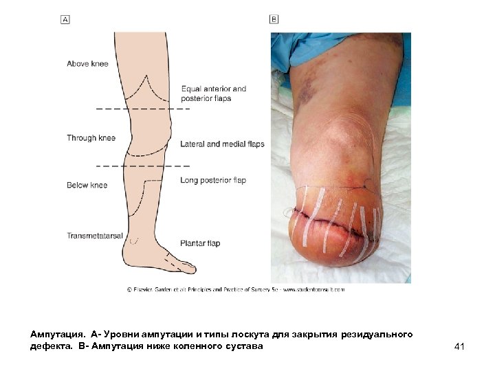 Ампутация. А Уровни ампутации и типы лоскута для закрытия резидуального дефекта. В Ампутация ниже