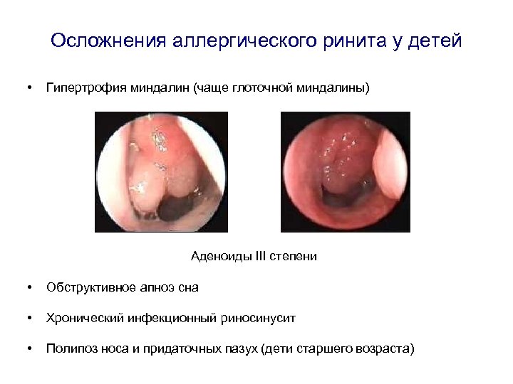 Осложнения аллергического ринита у детей • Гипертрофия миндалин (чаще глоточной миндалины) Аденоиды III степени