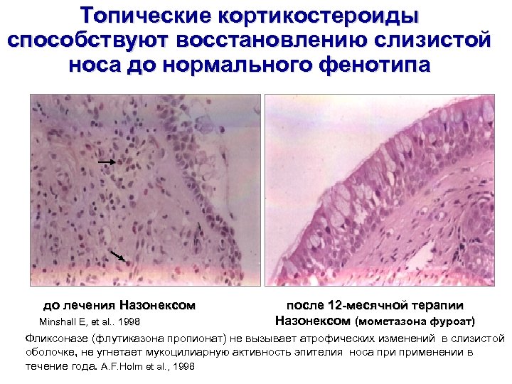 Топические кортикостероиды способствуют восстановлению слизистой носа до нормального фенотипа до лечения Назонексом Minshall E,