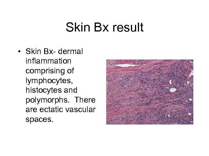 Skin Bx result • Skin Bx- dermal inflammation comprising of lymphocytes, histocytes and polymorphs.