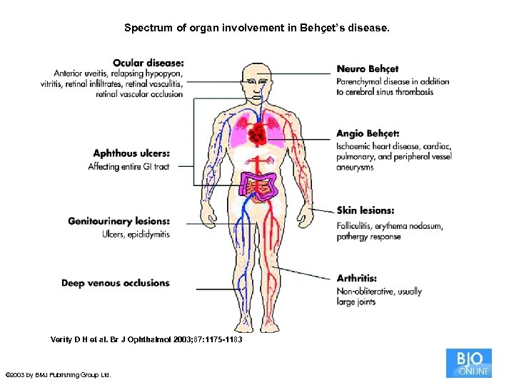 Spectrum of organ involvement in Behçet’s disease. Verity D H et al. Br J