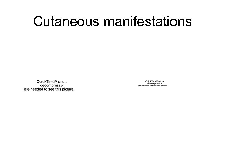 Cutaneous manifestations 