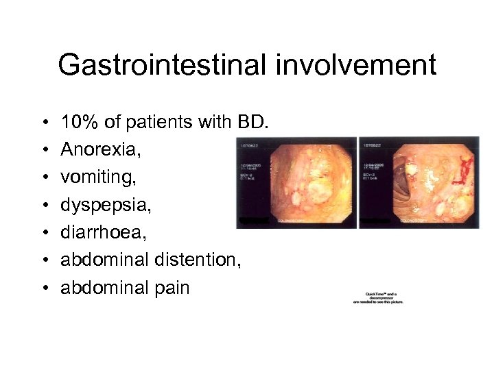 Gastrointestinal involvement • • 10% of patients with BD. Anorexia, vomiting, dyspepsia, diarrhoea, abdominal