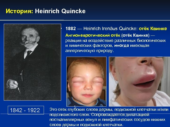 История: Heinrich Quincke • 1882 — Heinrich Irenäus Quincke: отёк Квинке Ангионевротический отёк (отёк