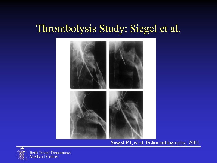 Thrombolysis Study: Siegel et al. Siegel RJ, et al. Echocardiography, 2001. 