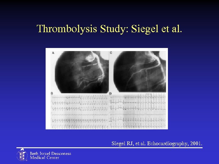 Thrombolysis Study: Siegel et al. Siegel RJ, et al. Echocardiography, 2001. 
